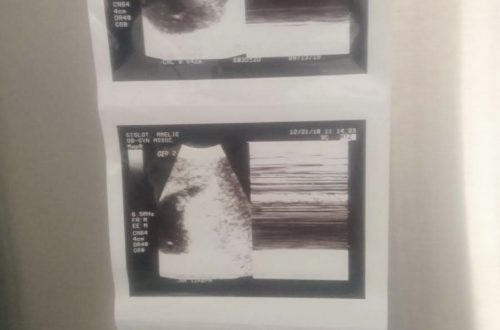 Une des premières échographies de bébé